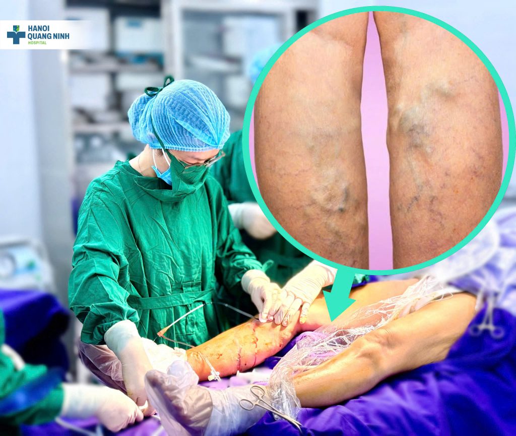 ĐIỀU TRỊ SUY GIÃN TĨNH MẠCH NÔNG CHI DƯỚI BẰNG ĐỐT SÓNG CAO TẦN (RFA)
