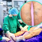 ĐIỀU TRỊ SUY GIÃN TĨNH MẠCH NÔNG CHI DƯỚI BẰNG ĐỐT SÓNG CAO TẦN (RFA)