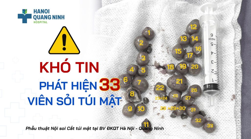 KHÓ TIN: PHÁT HIỆN 33 VIÊN SỎI CHEN CHÚC TRONG TÚI MẬT!